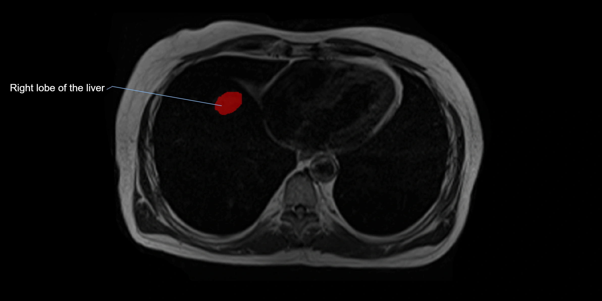 MRI liver lobe axial cross sectional 3T radiology  image-img-00001-00001.webp